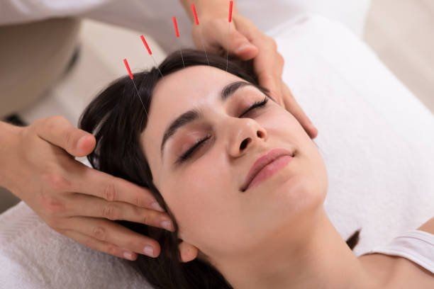 Woman receiving acupuncture therapy on her forehead while lying on a treatment table.